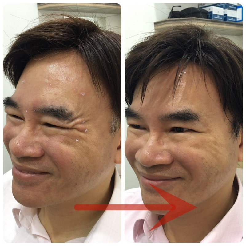 肉毒消除魚尾紋案例分享