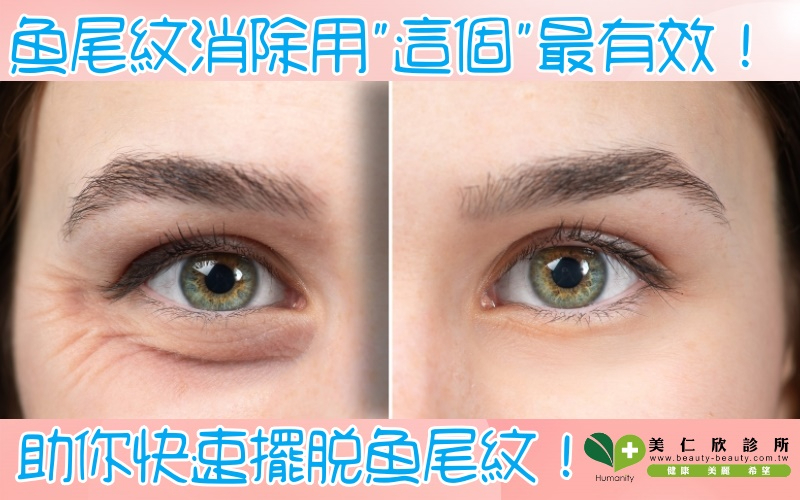 擺脫魚尾紋