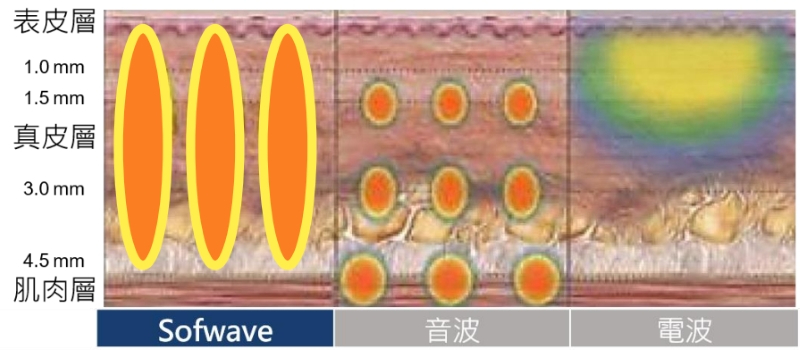 sofwave索夫波與電音雙波都是在改善全臉改善臉部鬆弛、臉部皺紋