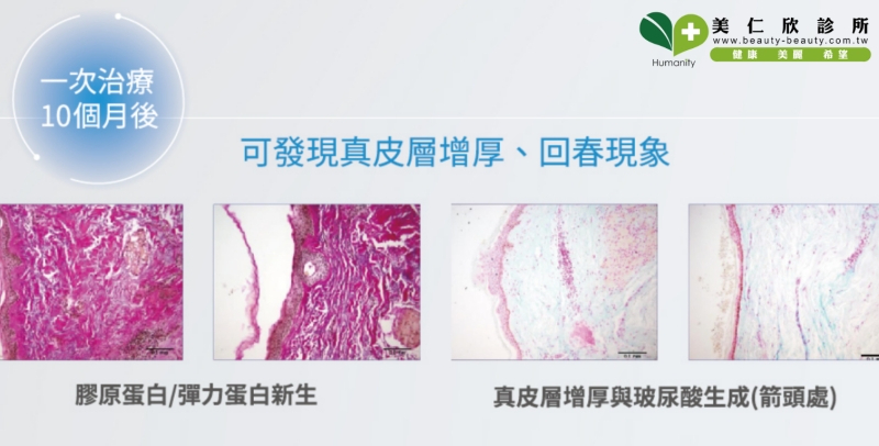 索夫波可以刺激膠原蛋白及彈力蛋白的增生