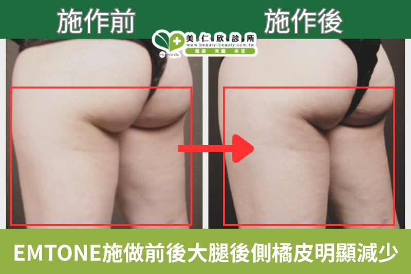 美仁欣診所消除橘皮案列