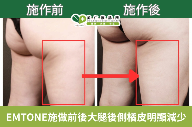 美仁欣診所消除橘皮案列