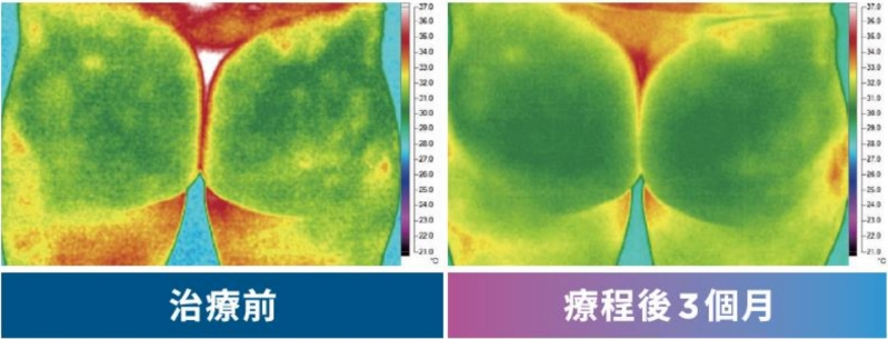 美仁欣診所消除橘皮案列