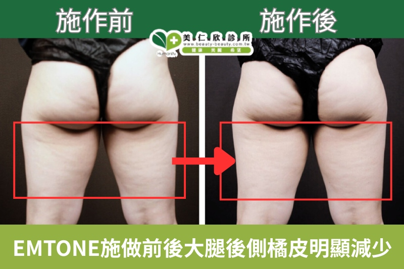美仁欣診所消除橘皮案列