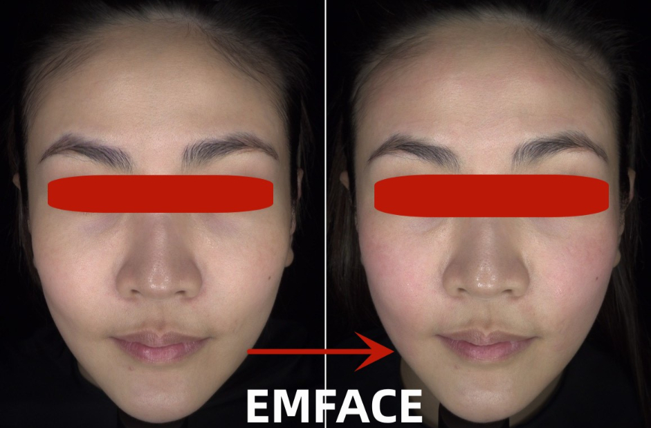 EMFACE真實案例
