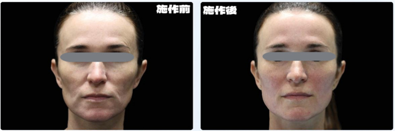 EMFACE效果案例分享-臨床實驗真實案例