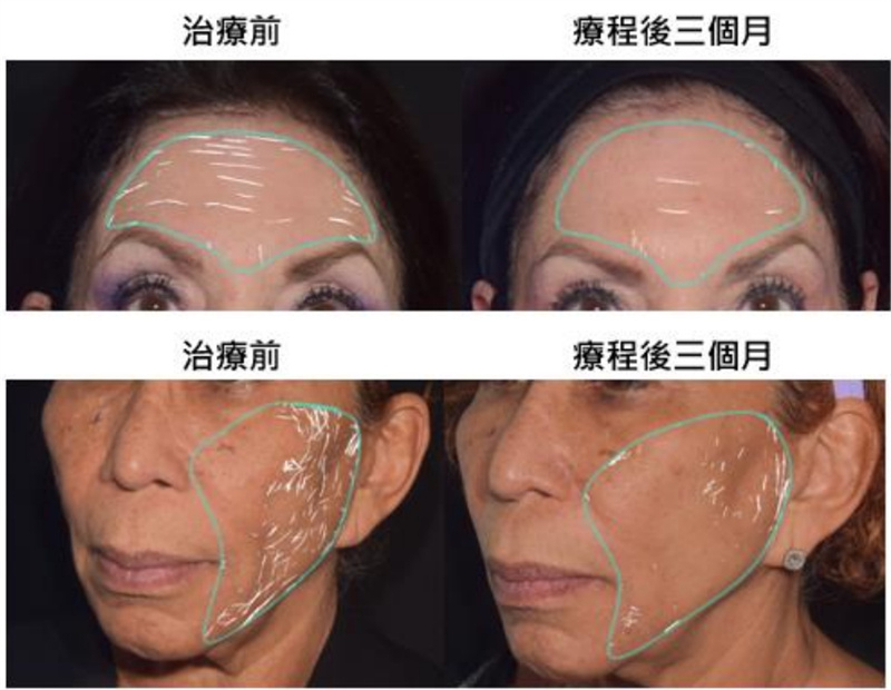 EMFACE效果案例分享-臨床實驗真實案例