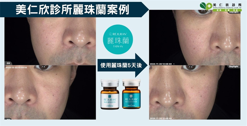 美仁欣診所麗珠蘭功效案例