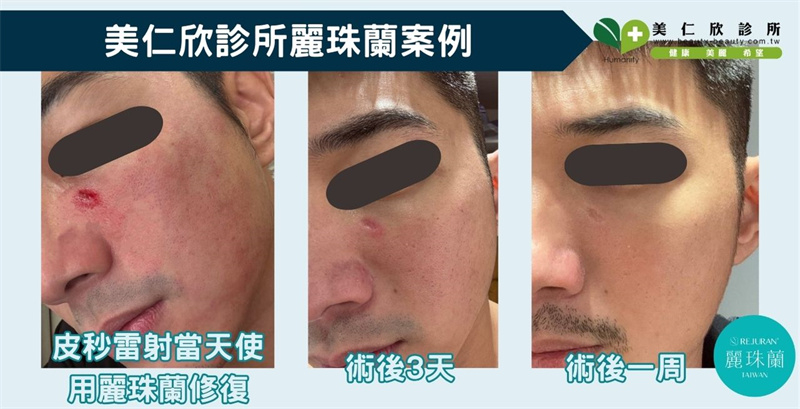 美仁欣診所麗珠蘭功效案例