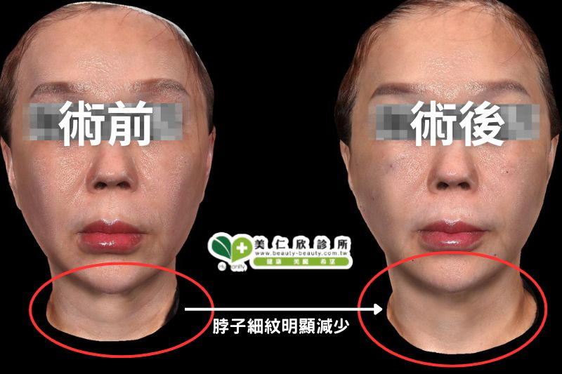 逆時針案例