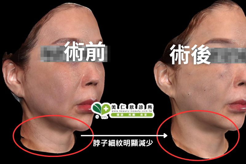 逆時針案例