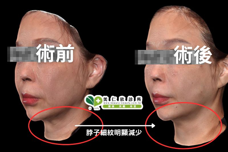 逆時針案例