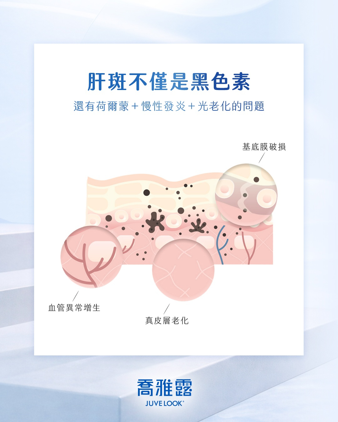 有肝斑困擾？喬雅露有機會幫上忙