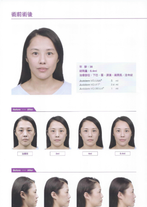 【玻尿酸拉提】NEW！全新臉部拉提概念（案例），逆轉你的外表！