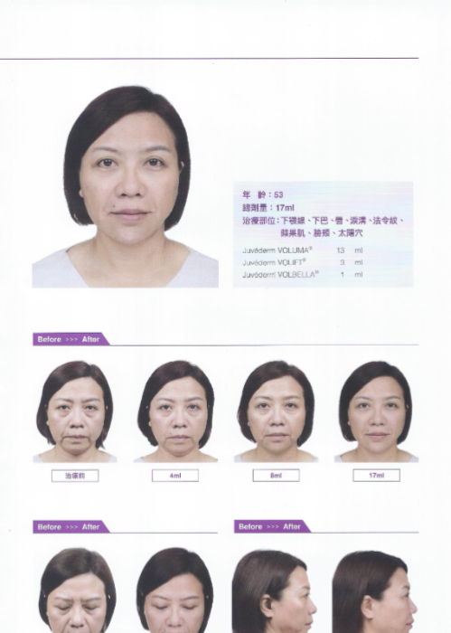 【玻尿酸拉提】NEW！全新臉部拉提概念（案例），逆轉你的外表！