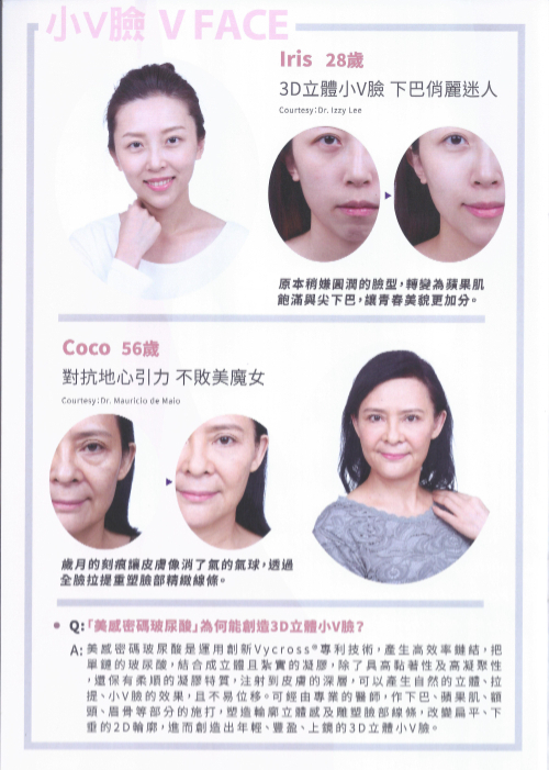 【玻尿酸拉提】NEW！全新臉部拉提概念（案例），逆轉你的外表！