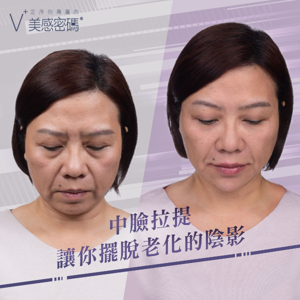 【玻尿酸拉提】NEW！全新臉部拉提概念（案例），逆轉你的外表！