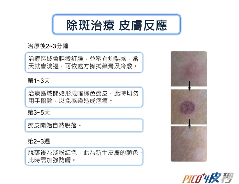 2022皮秒雷射價格｜5千能做嗎？恢復期多久？皮秒雷射功效有哪些？
