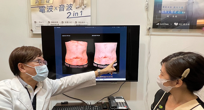 LifeViz 3D掃描技術_冷凍減脂心得與術後對比