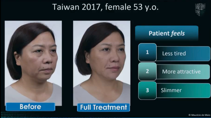 玻尿酸淚溝改善案例分享
