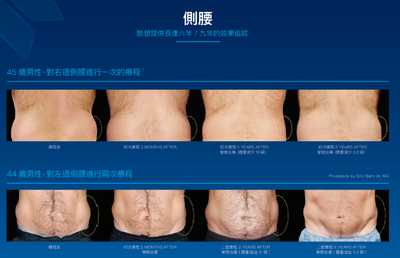 酷塑效果｜瘦身新寵兒！不可錯過的酷塑冷凍減脂6大優點