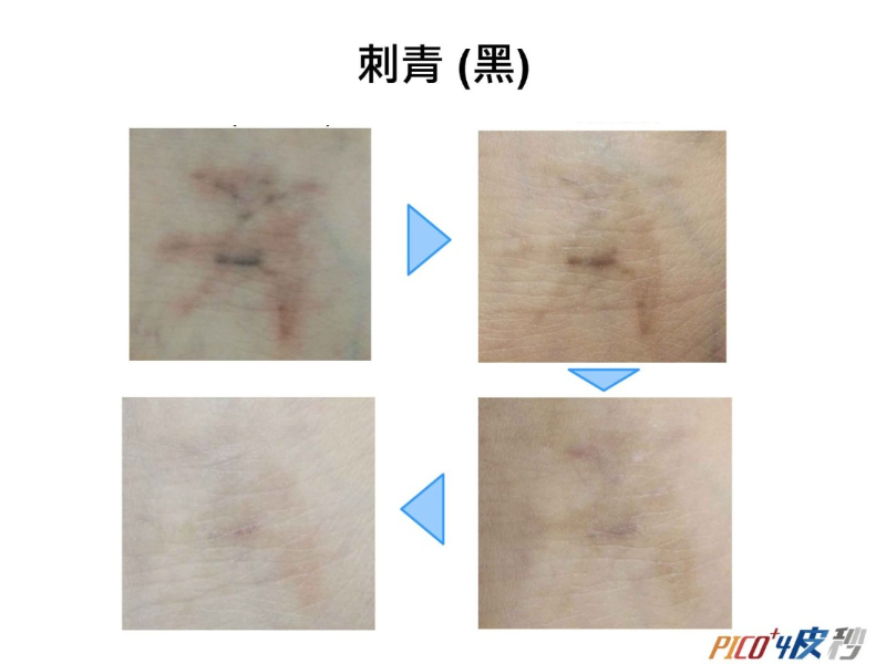 素人到女神！驚人的7大皮秒功效！但你知道皮秒是什麼嗎？