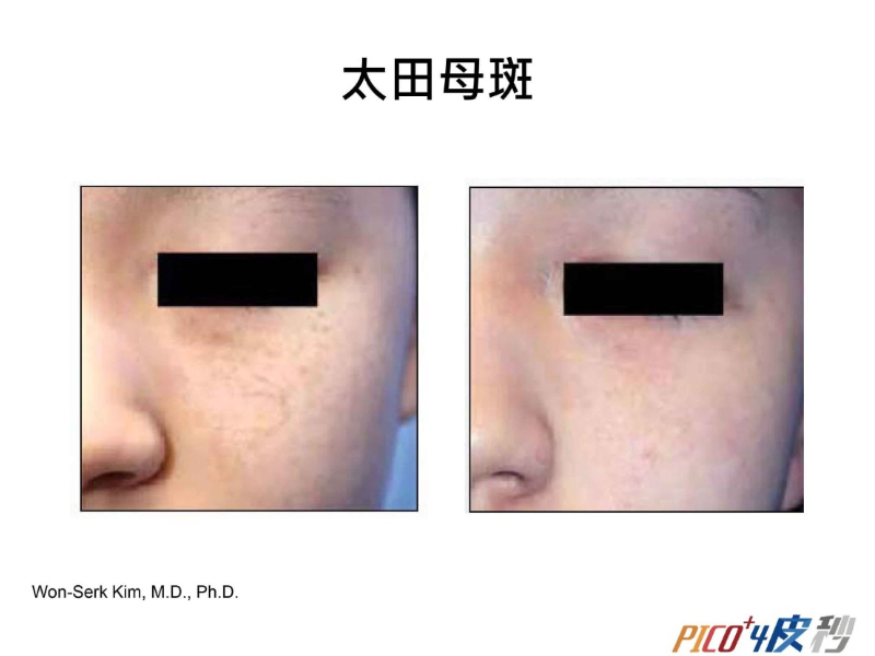 素人到女神！驚人的7大皮秒功效！但你知道皮秒是什麼嗎？