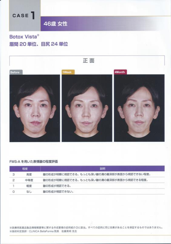 施打肉毒案例分享