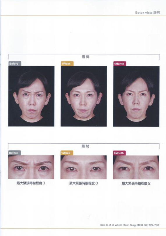 施打肉毒案例分享