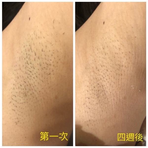 冰肌除毛效果超推薦！但冰肌除毛是什麼？【實際案例分享】