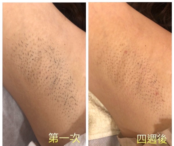 冰肌除毛效果超推薦！但冰肌除毛是什麼？【實際案例分享】