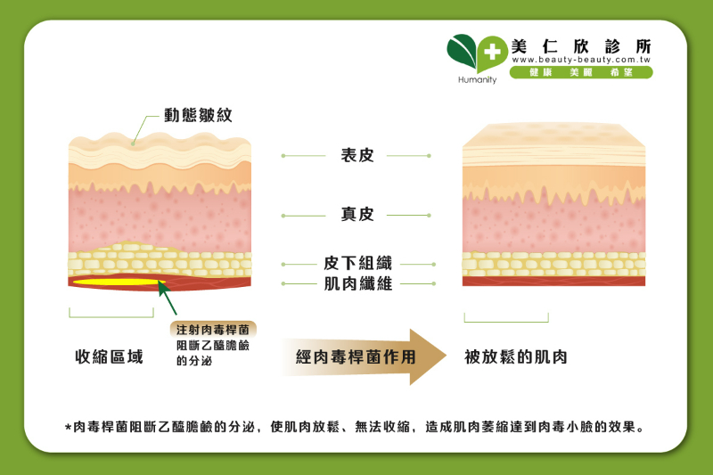 肉毒小臉新知－肉毒如何改善肌肉的呈現呢