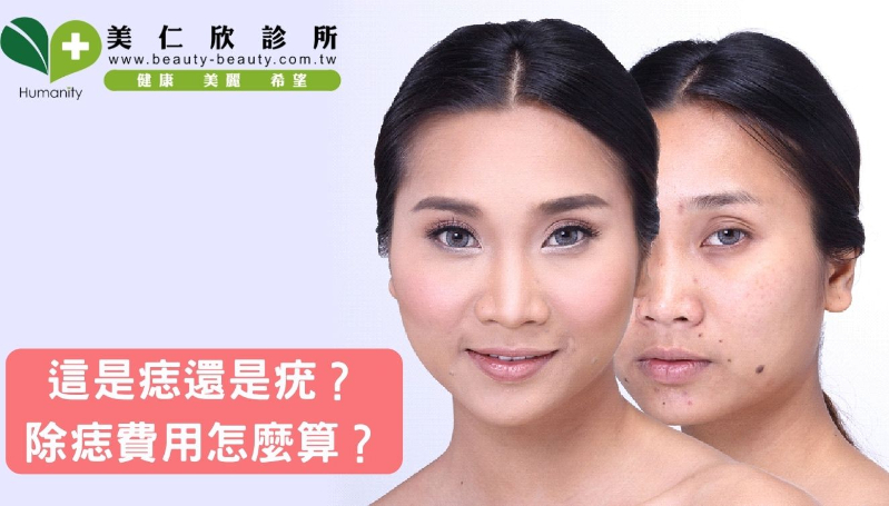 這是痣還是疣？除痣費用怎麼算