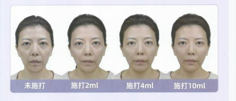 打玻尿酸效果