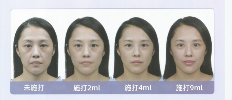 打玻尿酸效果
