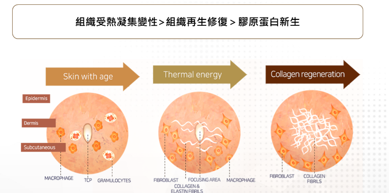 音波拉提醫美是什麼？音波拉提原理？