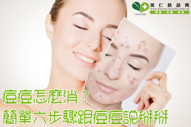 痘痘怎麼消？簡單六步驟跟痘痘說掰掰