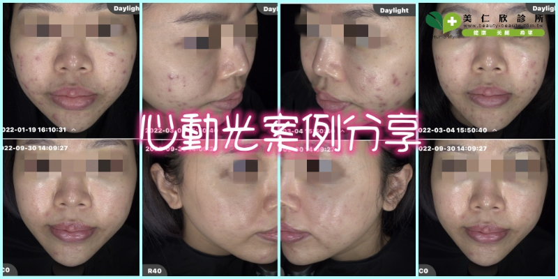 急性痘痘推薦痘痘醫美：揮別口罩痘痘肌心動光.以光養膚星動光
